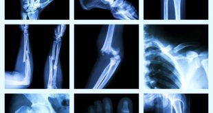 Best Personal Injury Lawyer In Utah Dans Injury Accidents Broken Bones & Injured Joints