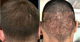 Should I Get A Lawyer for A Car Accident Reddit Dans 13 Benefits Fue Hair Transplant