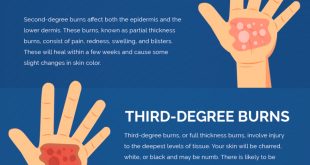 Personal Injury Lawyer Cost Dans Different Types Of Burn Injuries