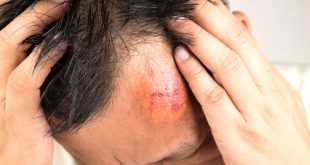 Car Accident Property Damage Lawyer Dans 17 Signs You Got A Concussion From A Car Accident Babcock Injury Lawyers